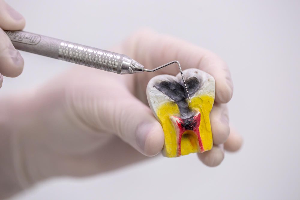 How is a Root Canal Done