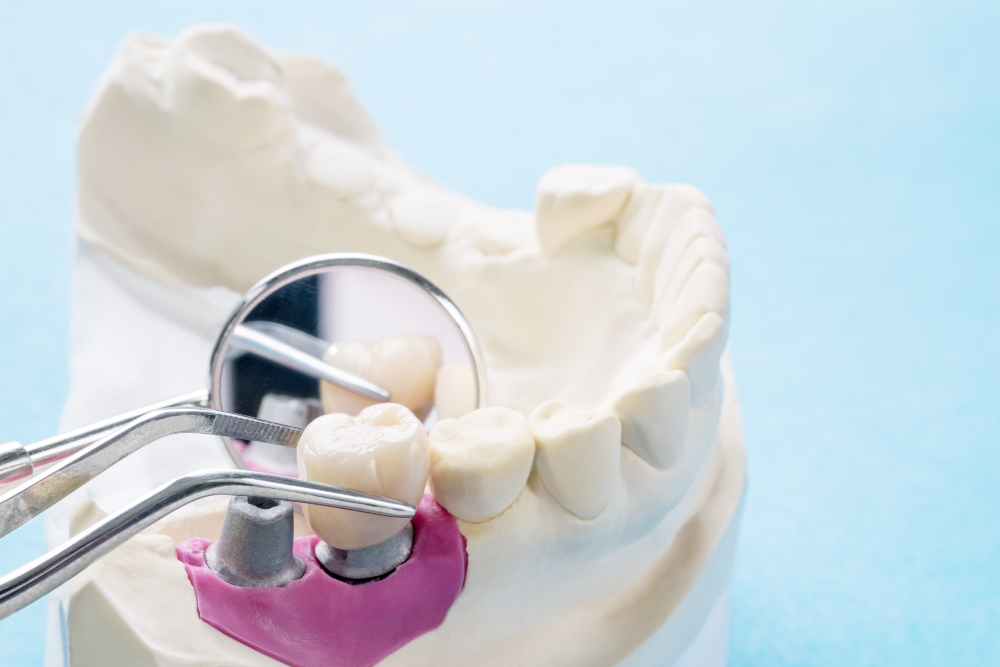 Permanent tooth replacement San Jose