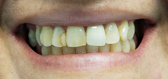 Before the Smile Treatment